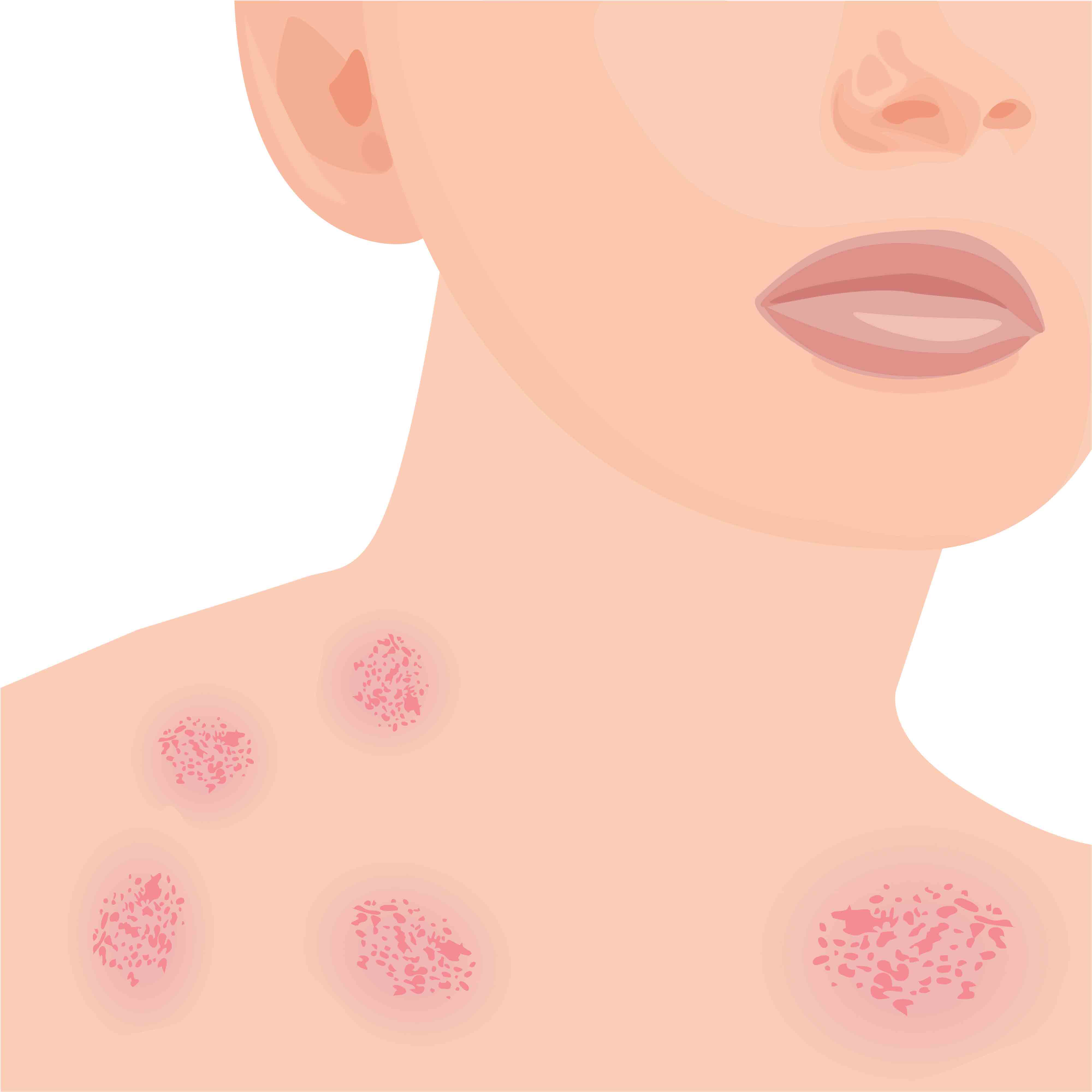 Holistic Treatment of Eczema in New York