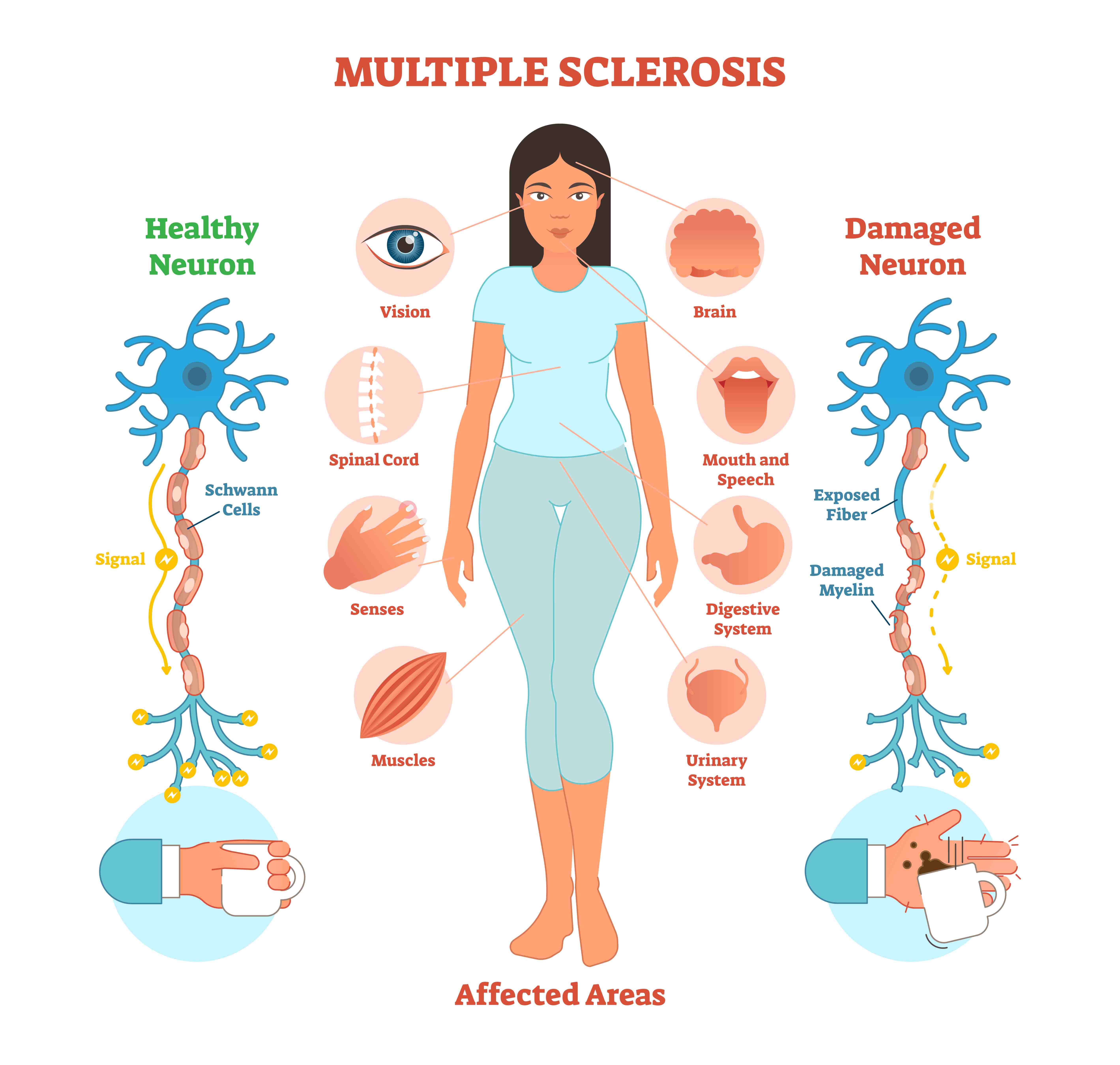 Holistic Treatment of Multiple Sclerosis in New York
