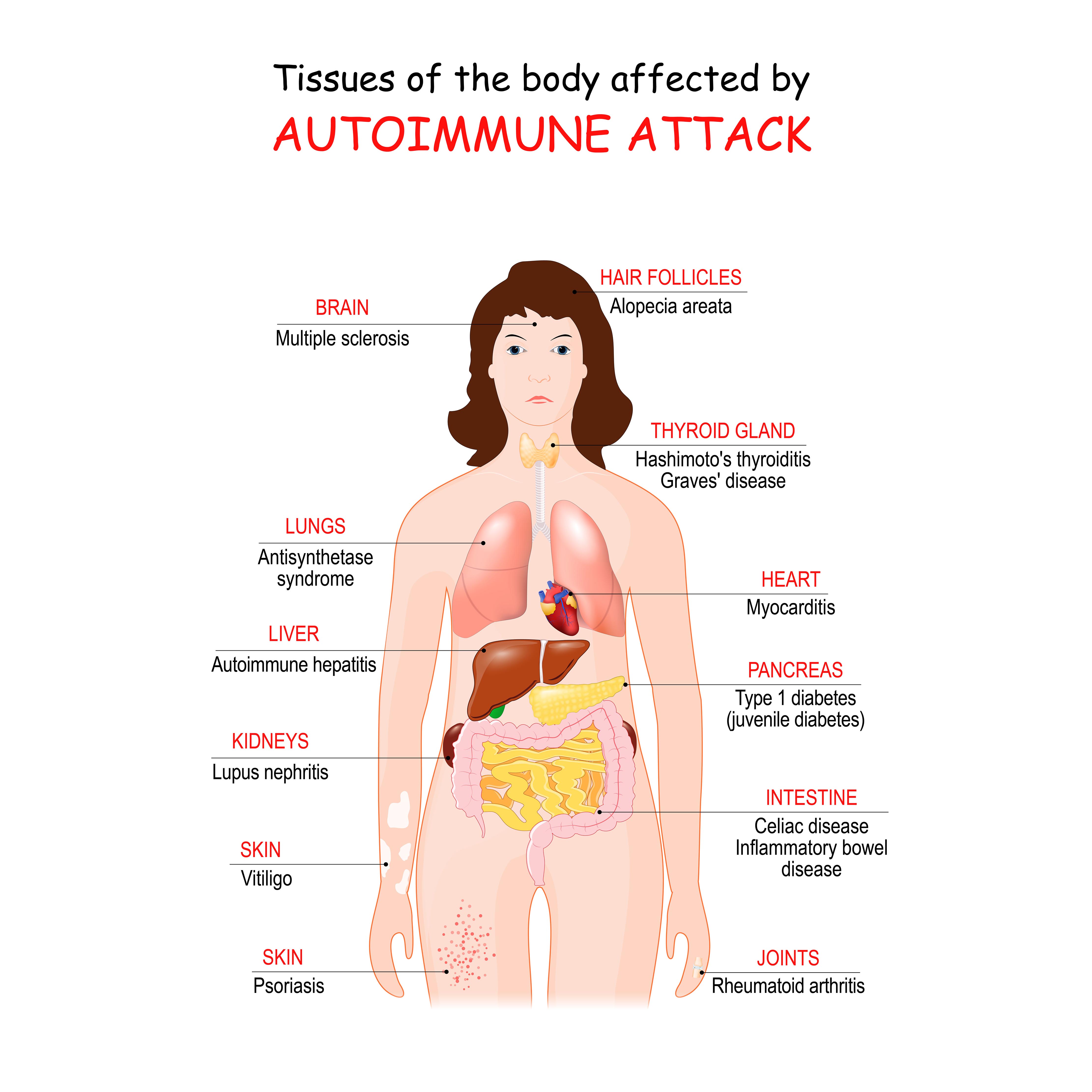 Tissue Body Effects of Autoimmune Disease